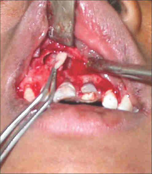 Figure 5: Platelet-rich fibrin application in periapical lesion in the region of upper anterior teeth Figure 6 :Platelet-rich fibrin application
