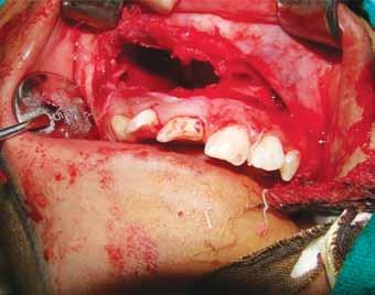 3: Intraoperative photograph showing wide surgical excision Fig.