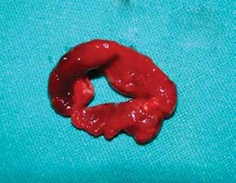 5: Enucleation done and cystic lining sent for histopathologic examination
