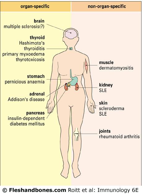 Examples of autoimmune diseases Organ-specific Multiple Sclerosis Juvenile Diabetes Systemic Systemic Lupus Erythematosus
