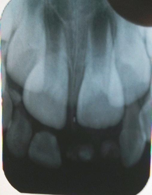 Fig: 2: Intra oral periapical radiograph showing