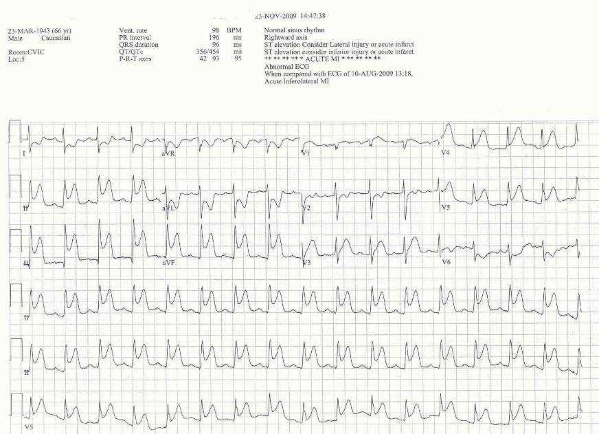 EKG #2 upon admission to ICU after
