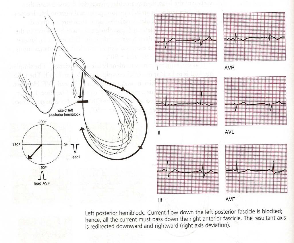 Right Axis Deviation from Left Posterior Hemiblock