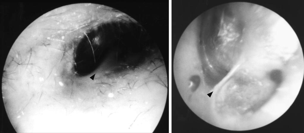 Figure 2. Membranous attachment (arrowheads) between the floor of the external auditory canal and the tympanic membrane. Left, Right ear. Right, Left ear.