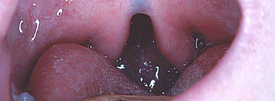 Feeding Less of an issue for isolated cleft lip Breastfeeding usually problematic Bifid uvula with submucosal