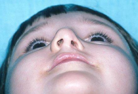 Nasal asymmetry