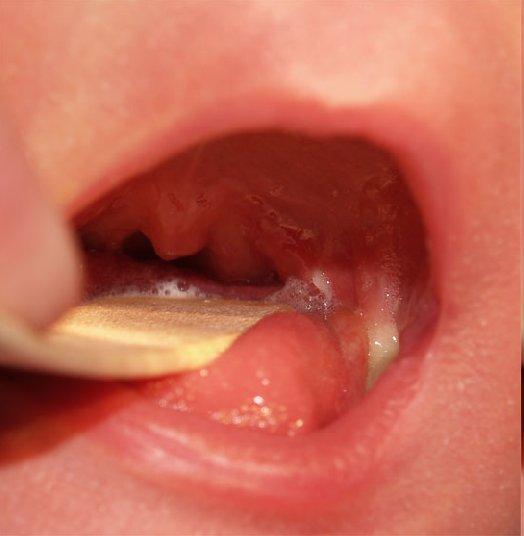 palate Bilateral cleft palate Complete vs.