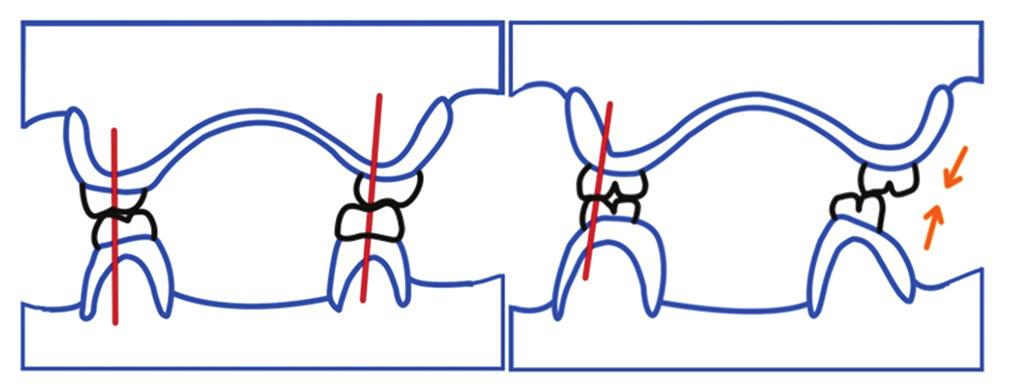 Rngrjn, et l.: Concepts of occlusion in prosthodontics- A literture review, prt II the ridges [Figure 2]. In the right lterl position, the cnine guidnce disocclude the posterior teeth [Figure 2].