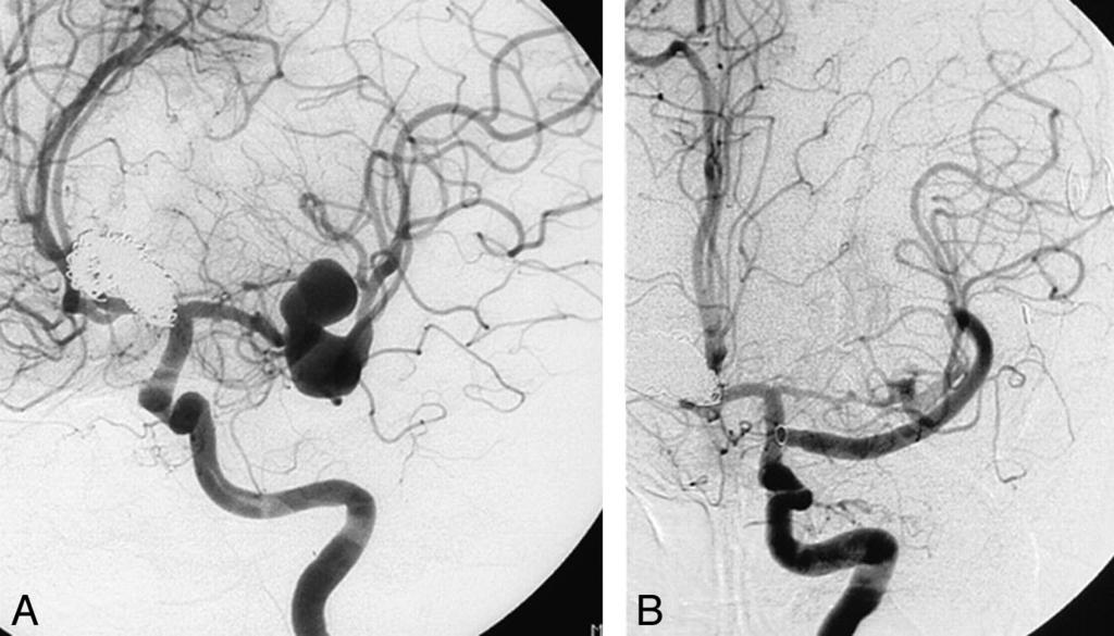 Fig 1. A 46-year-old woman with a coiled ruptured basilar tip aneurysm and an additional large fusiform middle cerebral artery aneurysm.