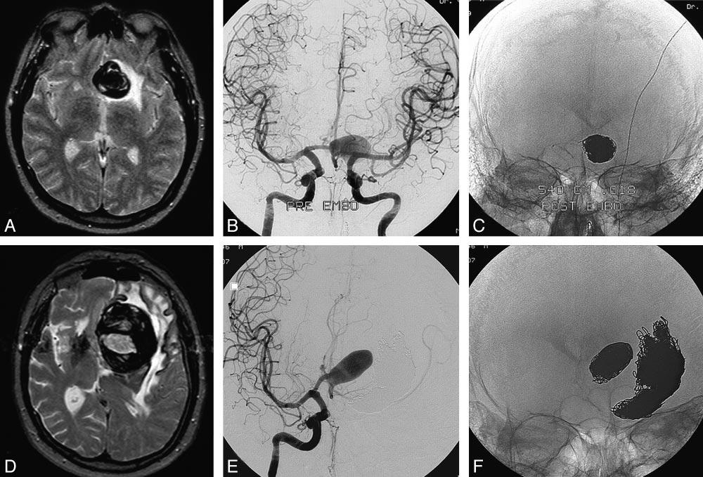 Fig 2. A 52-year-old man presenting with frontal syndrome. A, MR imaging reveals a partially thrombosed anterior communicating artery aneurysm with surrounding edema.