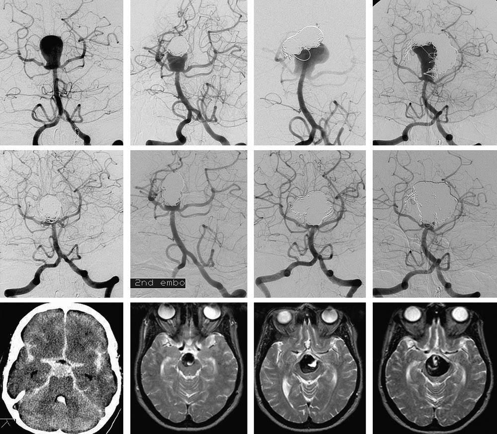 Fig 3. A 44-year-old woman with coiled ruptured basilar tip aneurysm with repeated reopening and progressive growth during 6 years time.