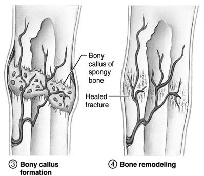 Fracture Repair Step 3: A.