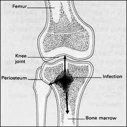 Clinical Conditions Osteomyelitis Osteo=bone + myelo=marrow + itis=inflammation.
