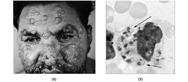 Phagocytosis Example (a) (b) Cutaneous leishmaniasis is a disfiguring disease caused by the intracellular flagellate Leishmania tropica, transmitted by the bite of a sand fly.
