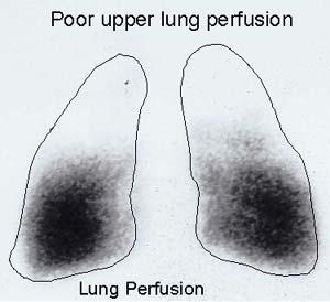 Surgical Options Lung Volume Reduction Complications Prolonged air leakage is the