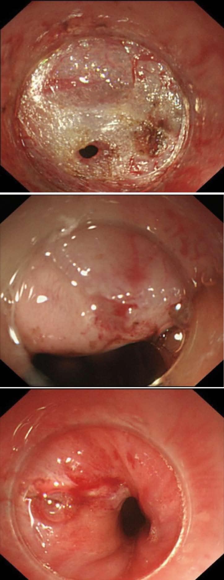 lumen). Figure 3 Two kinds of mucosal penetration under esophagogastroduodenoscopy.