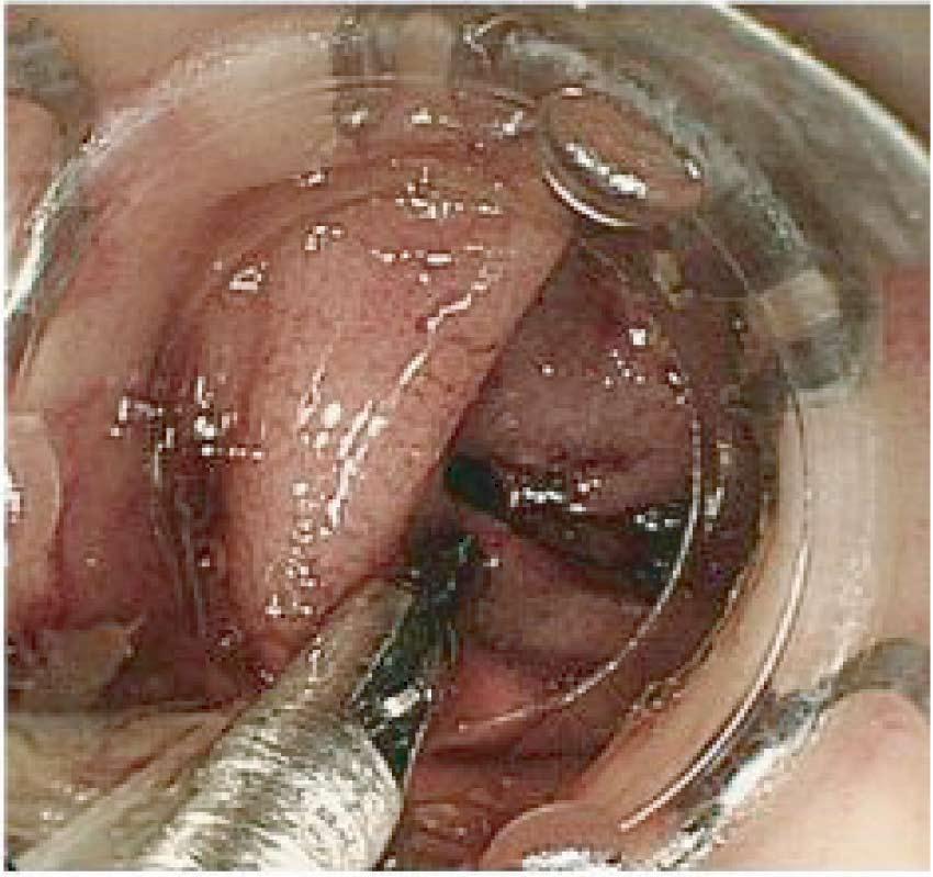 simple suction method after the failure of conventional endoscopic intervention.