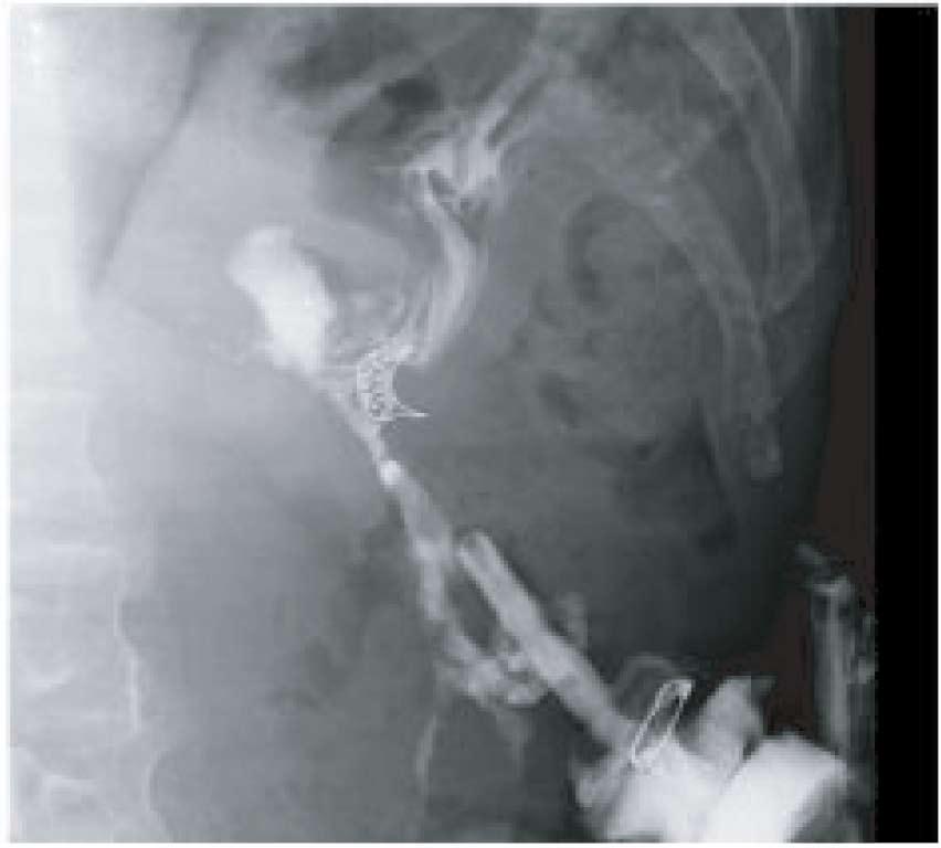 leakages occurred in two cases in the SS-group (D 10 and acute leakage and D 10 and chronic fistula).