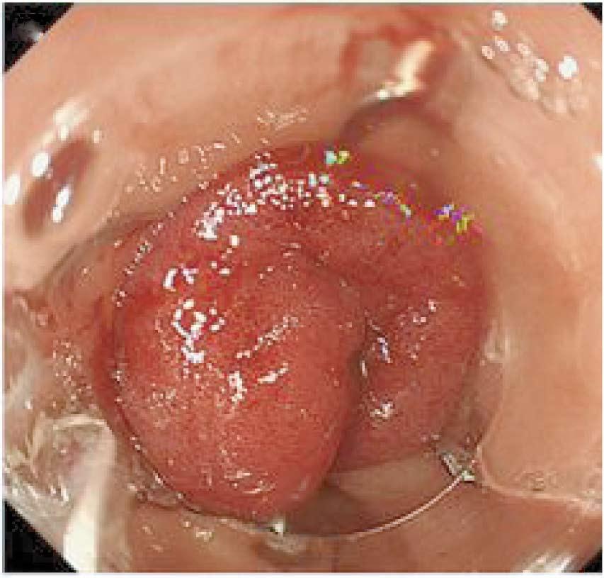 Moreover, OTSC system using TG assist after clinical failure of SS method is not applicable for the same defect, because it is difficult to remove endoscopically the deployed OTSC on the target
