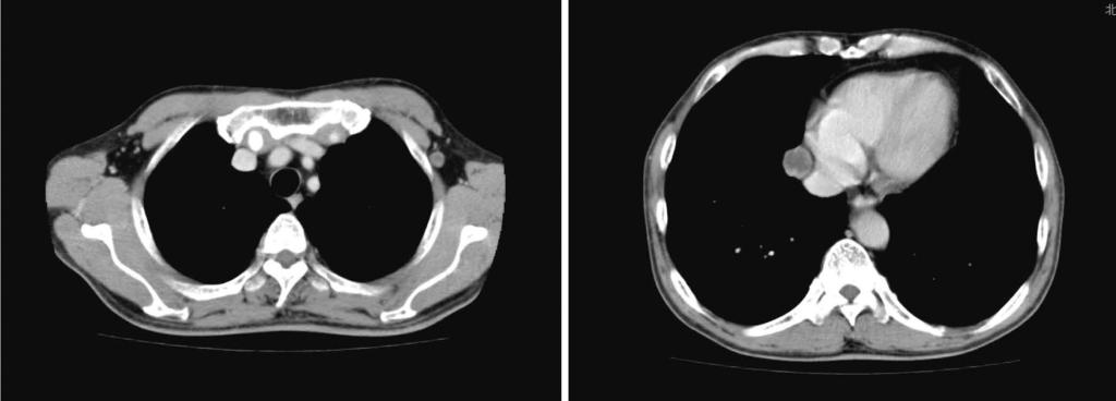 Kubo N et al. GIST with axillary lymph node metastasis A B Figure 2 Computed tomography reveals a tumor in the left axilla (A, diameter: 1 cm) and a tumor in the right mediastinum (B, diameter: 2 cm).