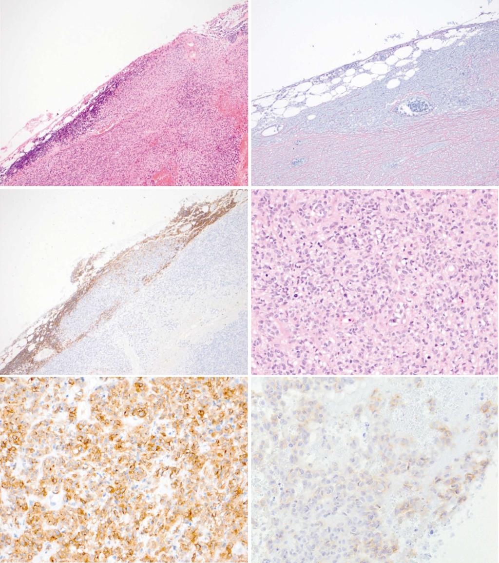 Analysis of the tumor revealed tunicate formation and the survival of lymphoid tissue [hematoxylin and eosin staining(a), silver impregnation (B), and Leukocyte common antigen (C) (magnification 40)].