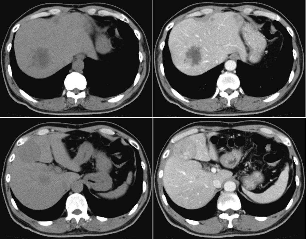 Aoki H et al. Liver metastases from leiomyosarcoma and adenocarcinoma S3 S8 Plain Enhanced S4 Figure 1 Computed tomography before treatment.