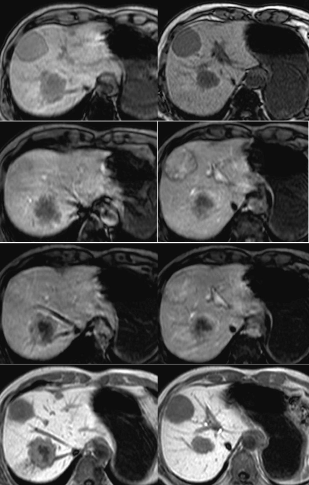 Aoki H et al. Liver metastases from leiomyosarcoma and adenocarcinoma A B Pre-enhancement 30 s 120 s Hepatocellular phase Figure 2 Ethoxibenzyl-magnetic resonance imaging before treatment.