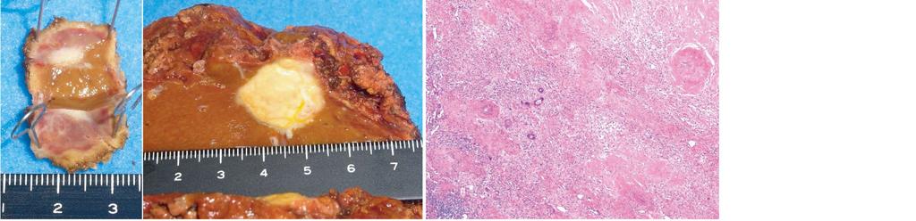 Chemotherapy effect: grade 2 S4 S4 S4 Spindle-shaped cell with eosinophilic cytoplasm and atypia α-sma positive CD34(-) c-kit(-) Figure 4 Pathological diagnoses of live lesions.