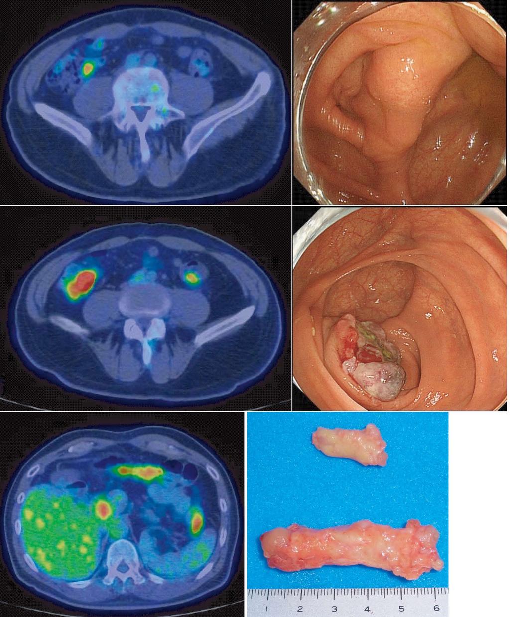 Aoki H et al. Liver metastases from leiomyosarcoma and adenocarcinoma 2010.9 2011.7 Leiomyosarcoma of cecum with lymph-node metastasis 2012.7 2012.10 α-sma(+) CD34(-) 2012.