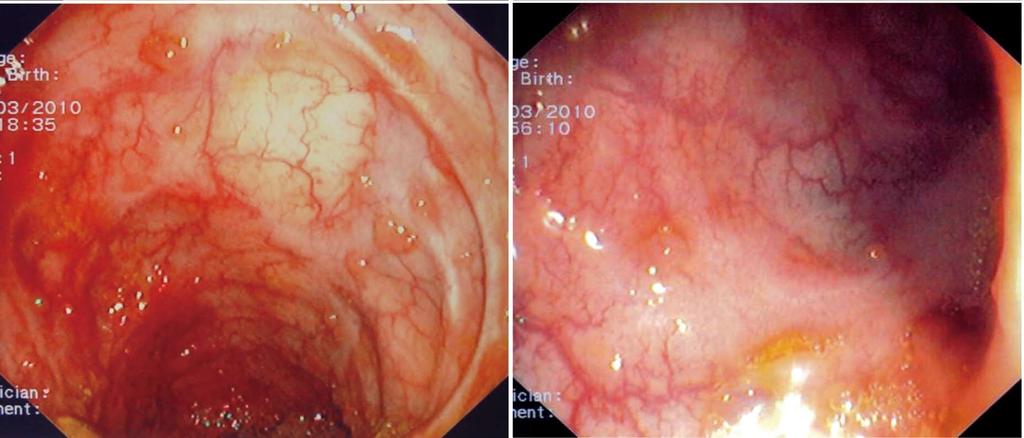Politis DS et al. Pseudopolyps in IBD I J Figure 1 Examples of various types of pseudopolyps in different patients with inflammatory bowel disease.