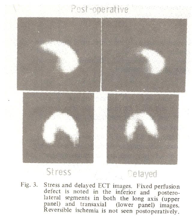 During the post operative stress test no apparent ST segment changes were seen.