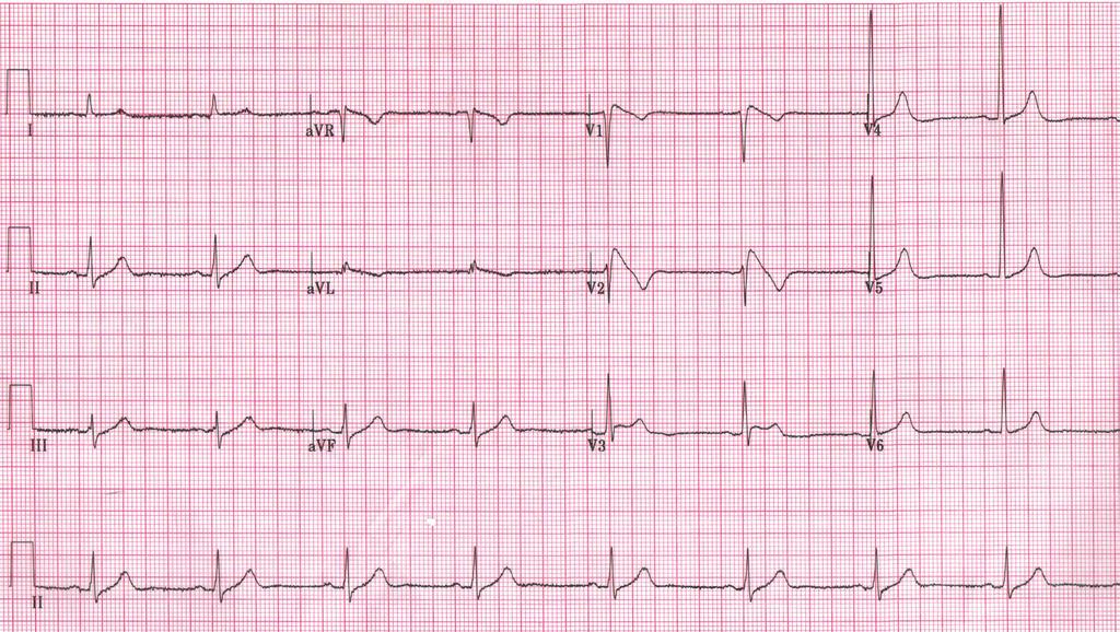 Electrocardiography Series Singapore Med J 2011; 52(9) : 647 CME Article Brugada pattern masking anterior myocardial infarction Seow S C, Omar A R, Hong E C T Cardiology Department, National