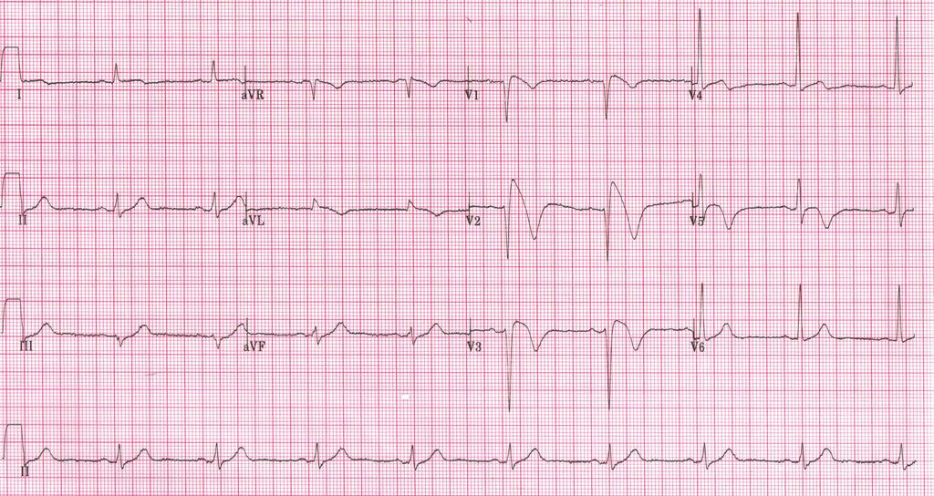 Singapore Med J 2011; 52(9) : 648 Fig. 2 Subsequent ECG shows evolving ST elevation myocardial infarction. ECG INTERPRETATION The first ECG (Fig.