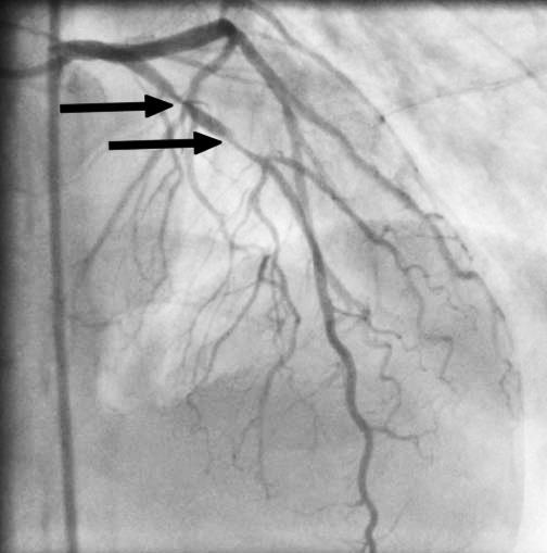 Singapore Med J 2011; 52(9) : 649 Fig. 3 Coronary angiogram shows the culprit lesions (arrows). Fig. 4 Brugada ECG pattern Types 1, 2 and 3. 18% 30% of families.