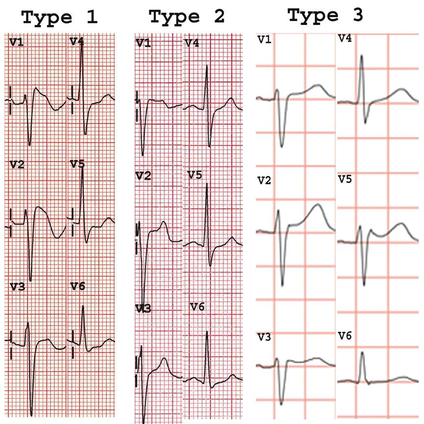 Ventricular myocardium comprises at least three electrophysiologically distinct cell types: epicardial, endocardial and M cells.