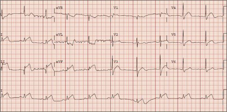 12-lead electrocardiogram from a 63-year-old man with chest discomfort after running on a treadmill, demonstrating ST elevation in lead III greater than in lead II; ST