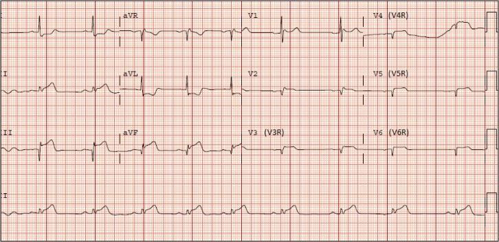 12-lead electrocardiogram from the same patient using right-sided precordial leads, demonstrating