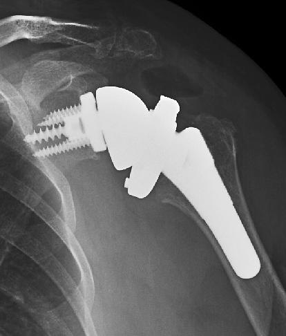 Treatment: Arthroplasty Reverse Shoulder Replacement (Results) Grammont s modification (invented