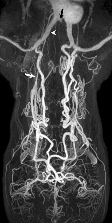 Clinicl Fetures of Tkysu Arteritis Fig. 1.