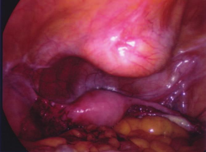 Review 2007;9:147 152 The Obstetrician & Gynaecologist Figure 1 Nodule of endometriosis in the bladder Introduction Endometriosis is a common and debilitating condition that can have a significant