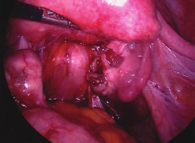 Review 2007;9:147 152 The Obstetrician & Gynaecologist Figure 2 Rectovaginal endometriosis Figure 3 Rectal resection specimen with endometriosis through the mucosa 150 The role of hysterectomy and