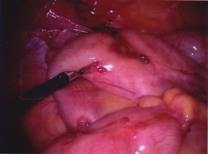 Digital examination may identify nodules in the uterosacral ligaments or cul-de-sac but the detection of a nodule per se, even one penetrating the posterior fornix, does not necessarily imply true