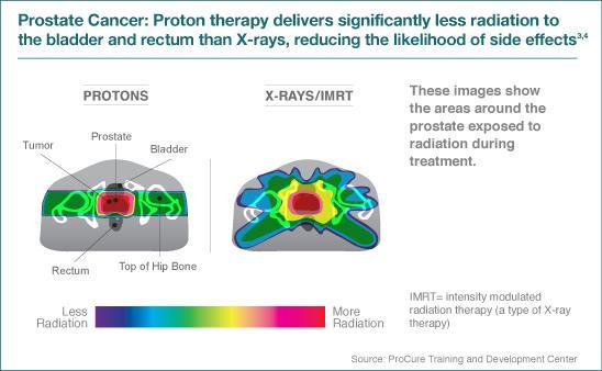 X-RAYS VS PROTON BEAM Proton Beam has a more narrow and specific area of effective treatment