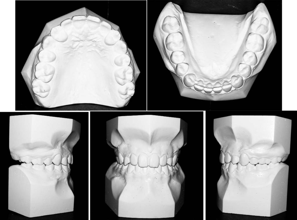 518 POTRUBACZ, TEPEDINO, CHIMENTI Figure 13. Posttreatment dental casts. mimic the canine bulge and avoid functional interference of the palatal cusp.