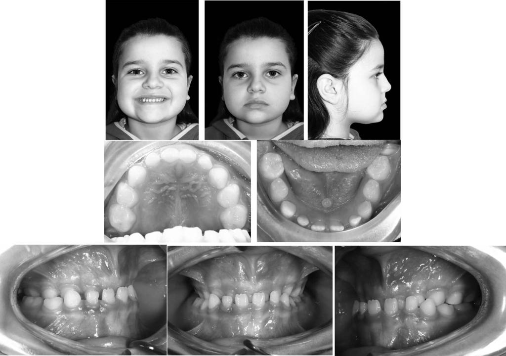 510 POTRUBACZ, TEPEDINO, CHIMENTI Figure 1. Pretreatment facial and intraoral photographs. female prevalence support this hypothesis.