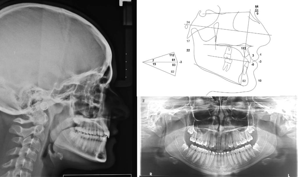 MAXILLARY TRANSPOSITION 517 Figure 11. Posttreatment panoramic radiographs, lateral cephalogram, and tracings. For this reason, a complete Mx.C.