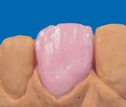 3. Dentine layering single crown Mixing a portion