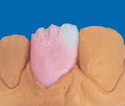 The DENTINE is reduced analogous to the build-up technique and smoothed with a moist brush.