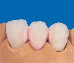 4. Dentine layering bridge The DENTINE and ENAMEL porcelains are built-up analogous to single crowns.