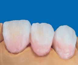 After completion of the first dentine firing, a small amount of DENTINE should be vibrated into the interdental spaces.